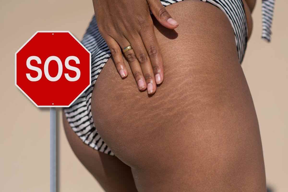 Smagliature e segnale SOS